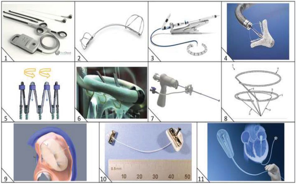 经导管瓣膜修复术费用,经导管瓣膜植入术风险