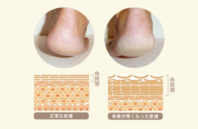 一条精选|干裂的脚后跟，有救了！