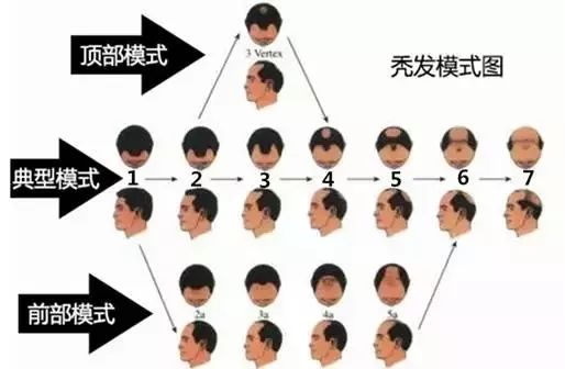 预防脱发和让头发变多的方法,春季脱发吃什么好得快