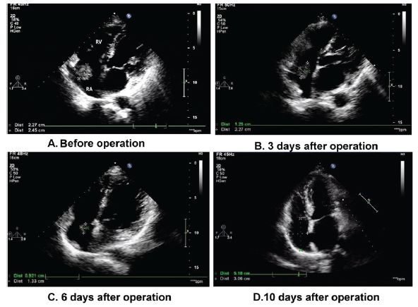 picc置管术后血栓形成处理,picc置管出现血栓后医院怎么溶栓
