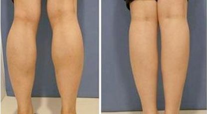 外用涂抹式肉毒素可以祛皱纹吗,去皱纹的肉毒素一年打几次为佳