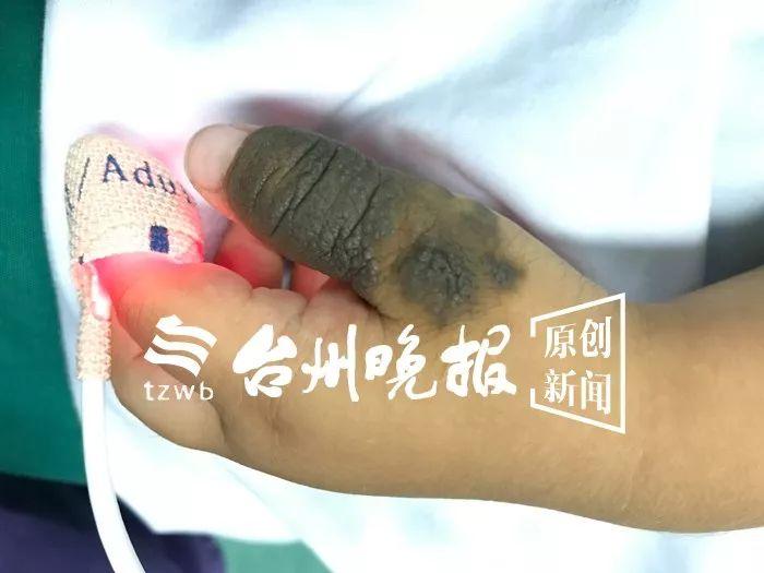 可怜！3岁娃得怪病身上长满“兽皮”，千里寻医到台州