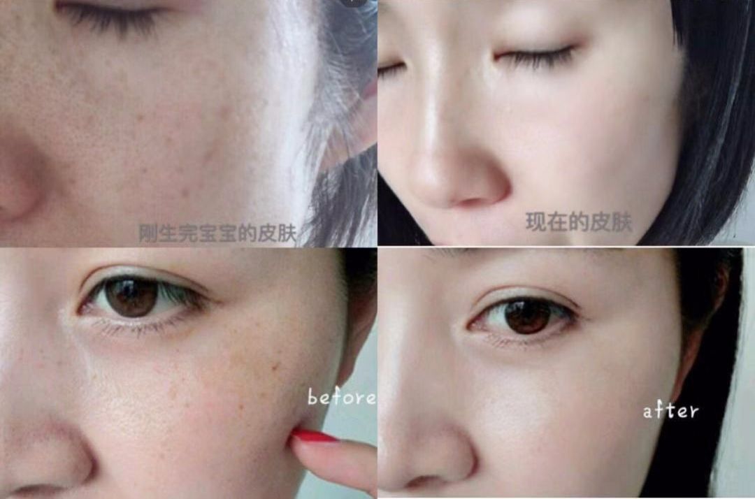 祛斑美白补水祛皱祛痘,祛斑祛痘美白改善暗沉
