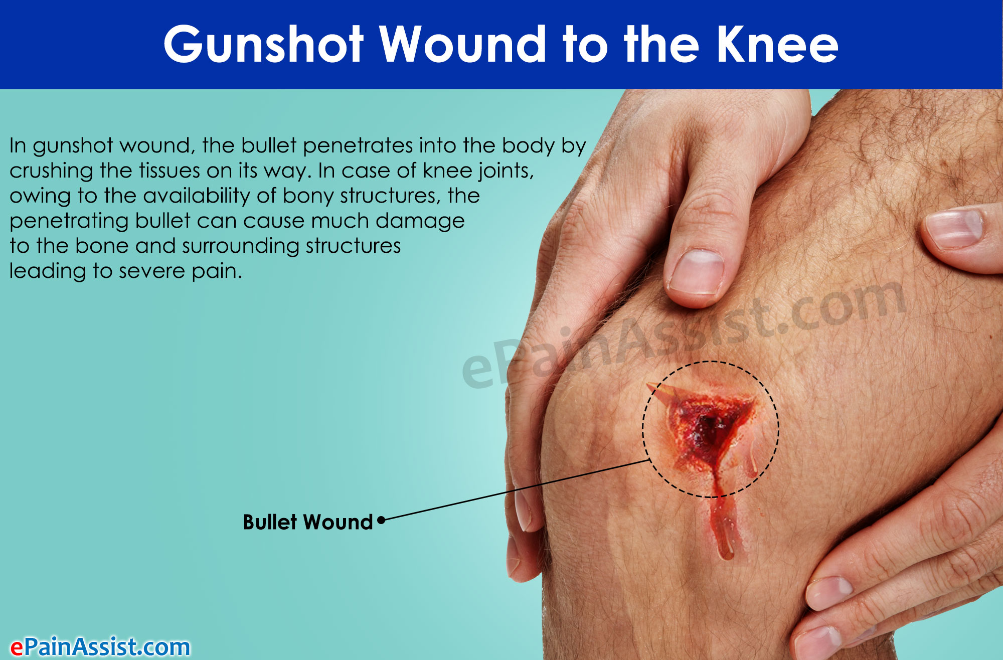 人体中弹会怎么样,人体中枪后果