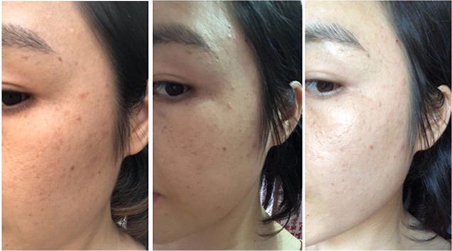 5个祛斑小妙招淡化晒斑雀斑痘印,晒斑痘印怎么消除的最快方法