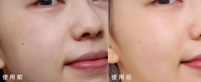 5个祛斑小妙招淡化晒斑雀斑痘印,晒斑痘印怎么消除的最快方法