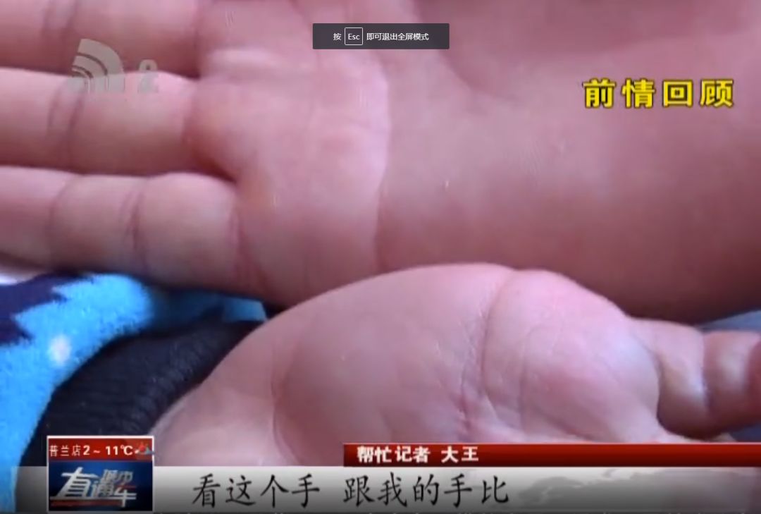 帮忙大小王|留守儿童手肿像水球大王帮忙查明病因