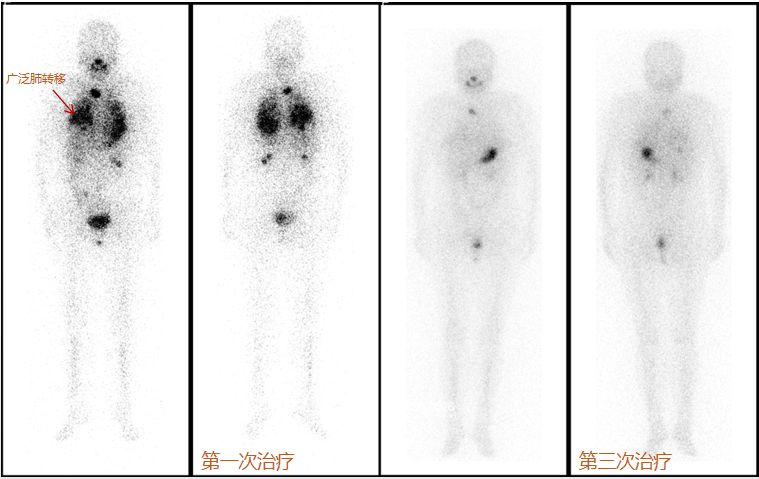 甲状腺癌远处转移碘131效果好吗,甲状腺癌转移远处tg会有变化吗