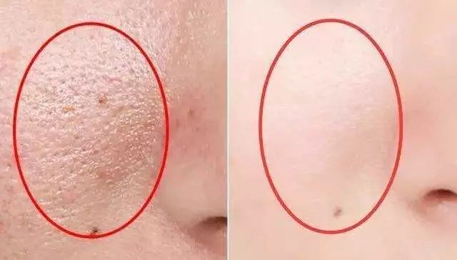 用了几天火山泥为什么还毛孔粗大,怎样用韩国进口火山泥洗脸