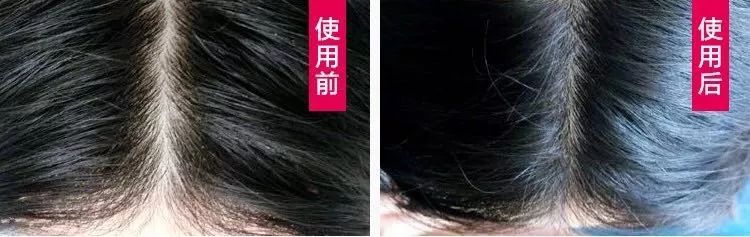 养发防脱拯救发际线洗发水,生发发际线的神器测评