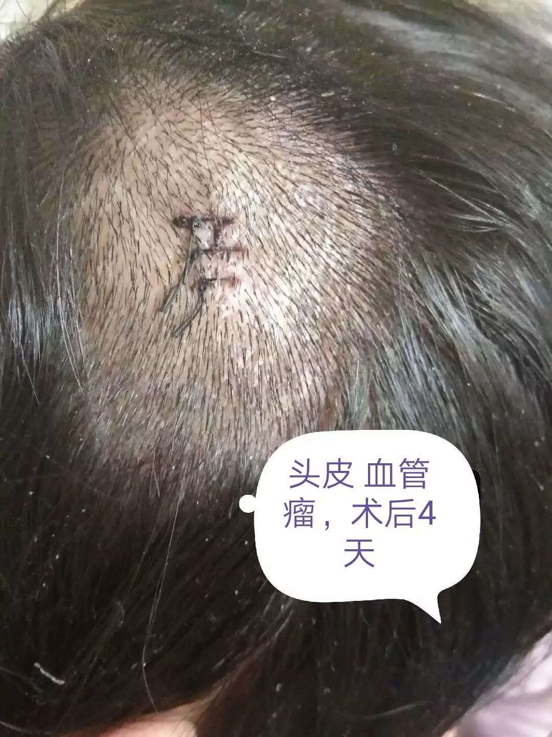 小小黑痣该不该治？该如何治？
