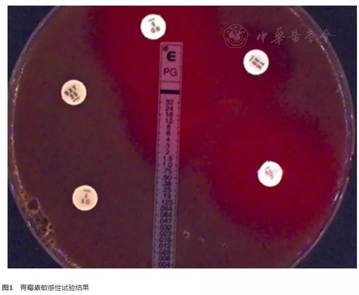 呼吸道分离425株肺炎链球菌耐药性变化趋势分析