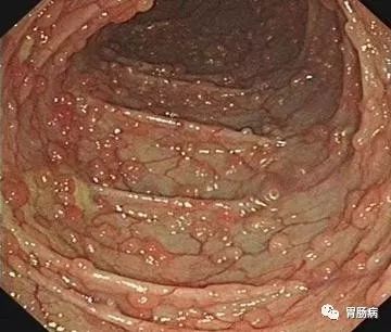 容易癌变的息肉有哪些,什么样子的息肉容易癌变