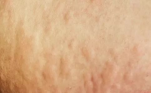 蚊虫叮咬快速止痒的中医方法,超好用的止痒消肿的药膏蚊虫叮咬