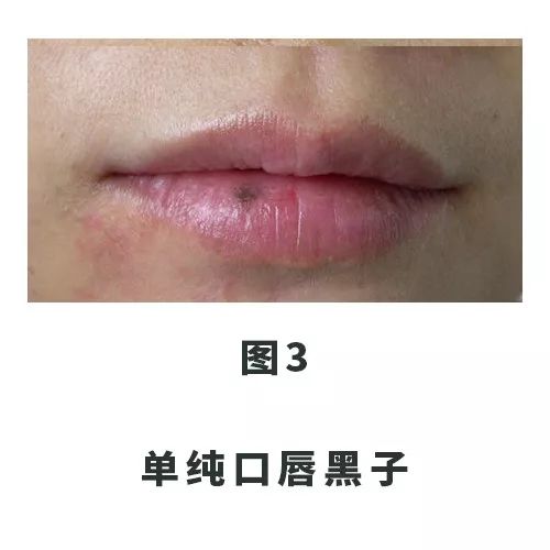 口唇有黑斑怎么消除,口唇上有黑斑是怎么回事