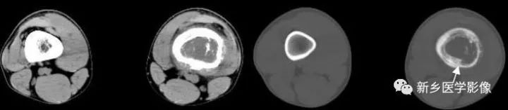 骨骼疾病怎么调理最有效,骨骼坏死最佳治疗方法