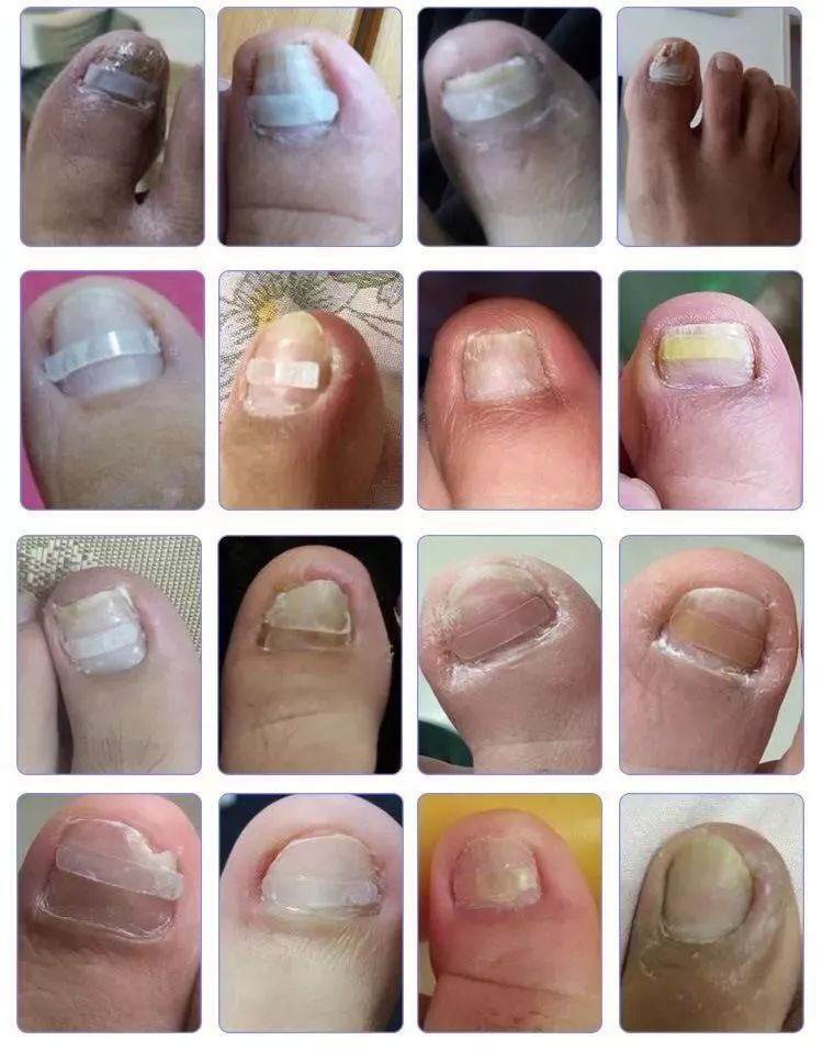 小脚趾甲长在肉里一碰就疼怎么办,指甲扎到肉里怎么处理