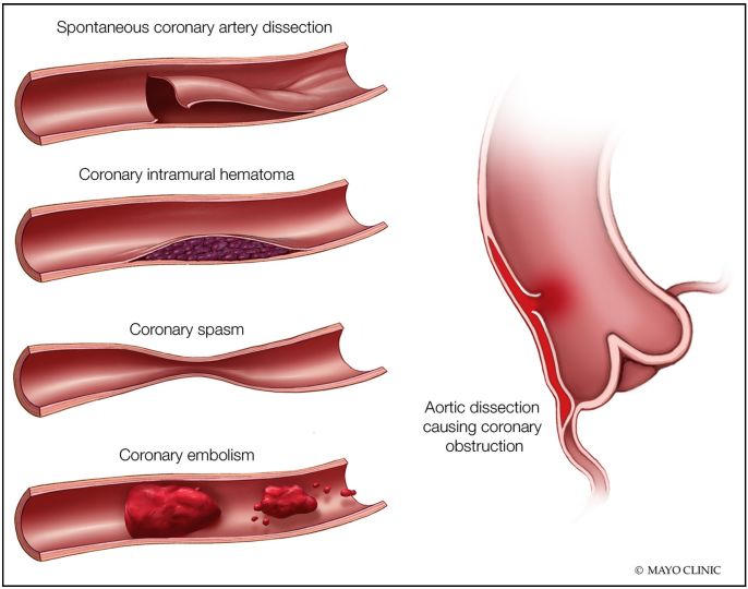 急性st段抬高型心肌梗死指南2019,什么是急性非st段抬高型心肌梗死