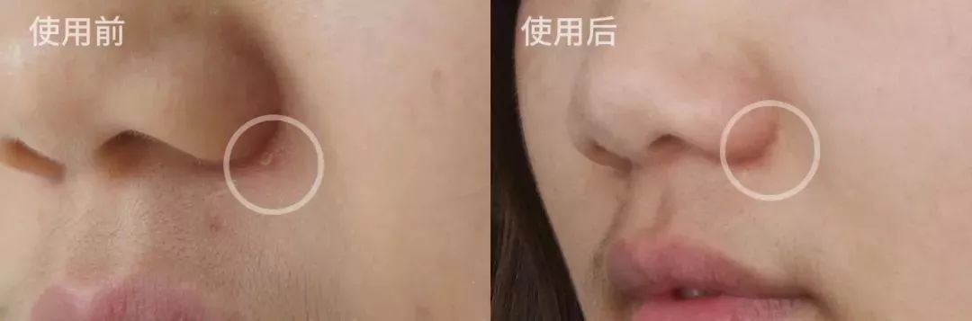 战痘神器祛痘效果怎么样,战痘神器推荐