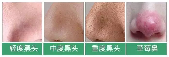 白头黑头到底拔不拔,黑头反反复复如何根治