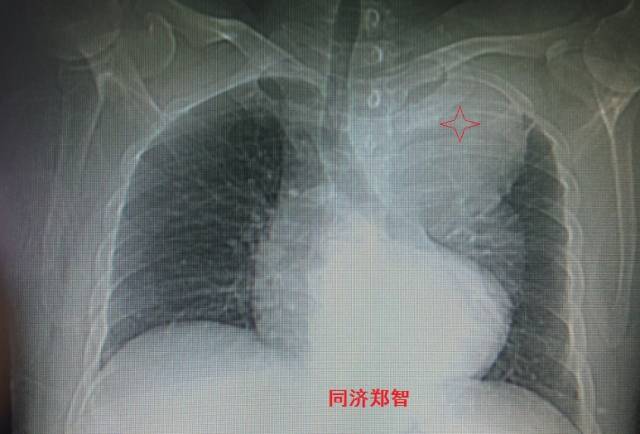 主动脉夹层cta能扫描出来吗,急性主动脉夹层cta影像诊断与鉴别