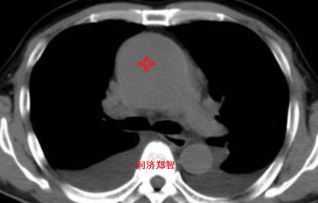 没有cta这三招也能识别主动脉夹层,磁共振可以替代cta检查主动脉夹层