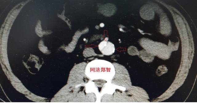 主动脉夹层cta能扫描出来吗,急性主动脉夹层cta影像诊断与鉴别