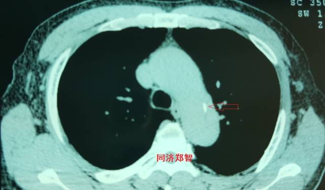 主动脉夹层cta能扫描出来吗,急性主动脉夹层cta影像诊断与鉴别