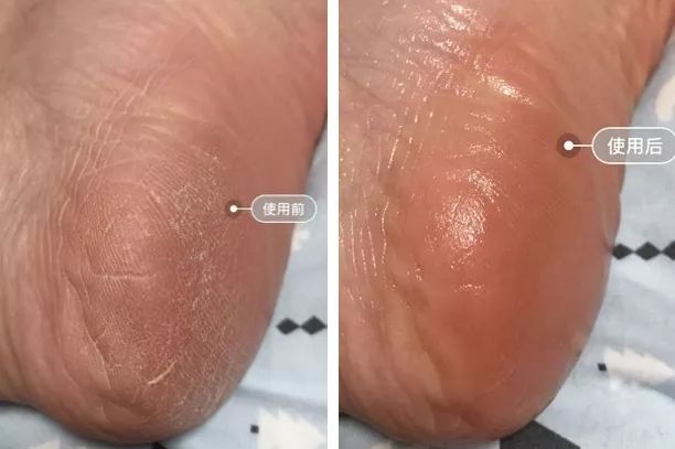 脚后跟套上这个“*钟金**罩”夏季穿鞋嫩到反光！干裂、老茧、死皮都没了！