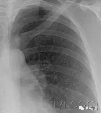 胸部解剖及常见疾病影像表现,胸部影像学基础知识