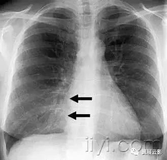 胸部解剖及常见疾病影像表现,胸部影像学基础知识