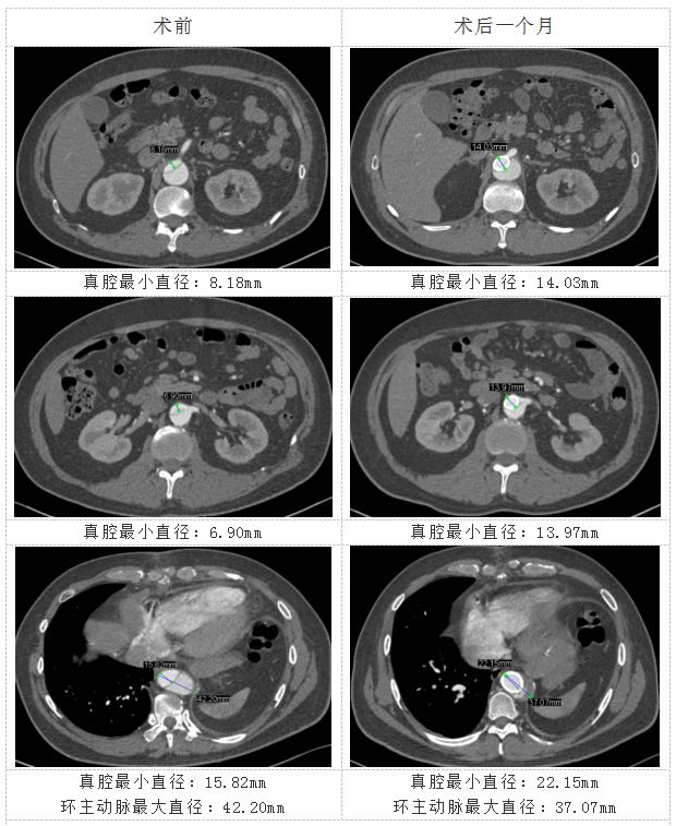 华西主动脉夹层手术怎样,再次救治急性主动脉夹层取得成功