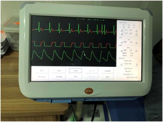 光山县人民医院：体外反搏治疗后，他拥有了“孩子般的睡眠”