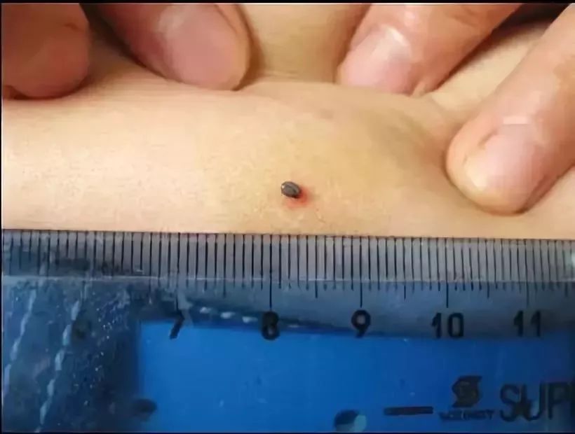 2岁男孩眼皮上突然冒出一个小黑点！医生：这东西会要命！眼下高发，别大意！