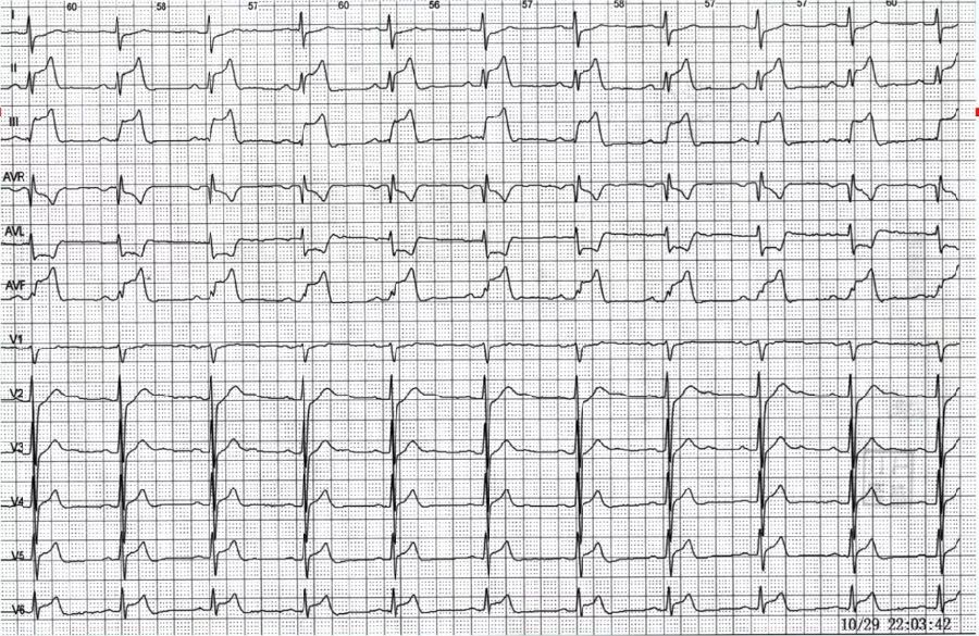 陈静：胸痛心电图的诊断与鉴别诊断｜CCIF2019