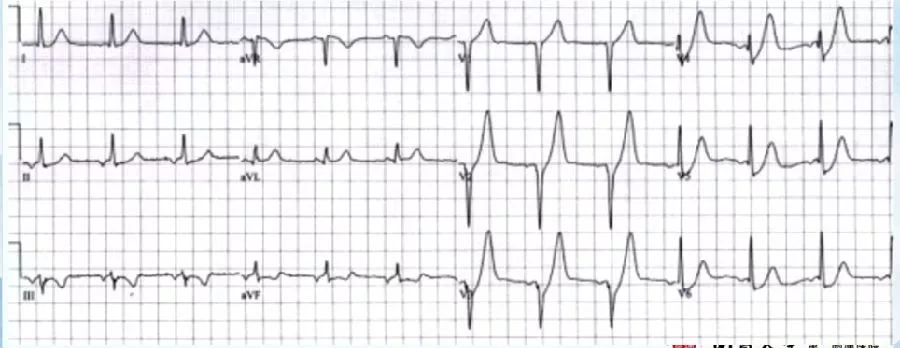 胸痛心电图表现,胸痛的心电图鉴别诊断