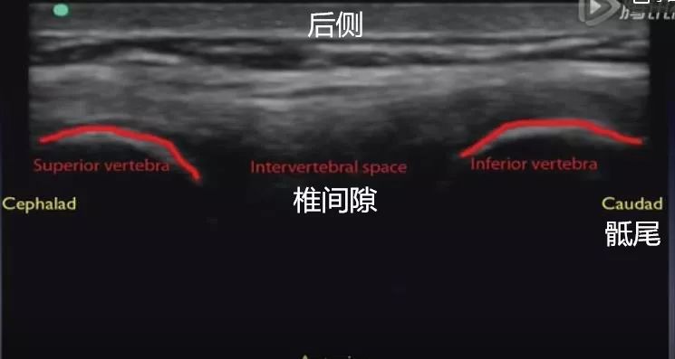 超声应用之穿刺定位