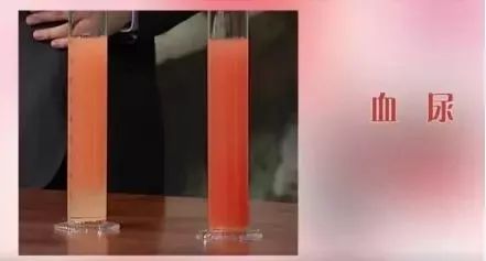 有一种尿的颜色或是癌症信号，赶紧检查一下你尿液的颜色！