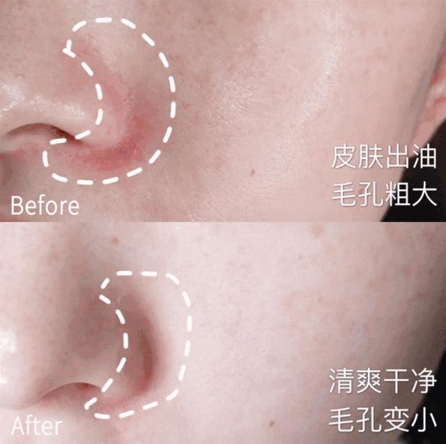 鼻尖挤出白色的是什么,鼻子上挤出的白丝怎么解决