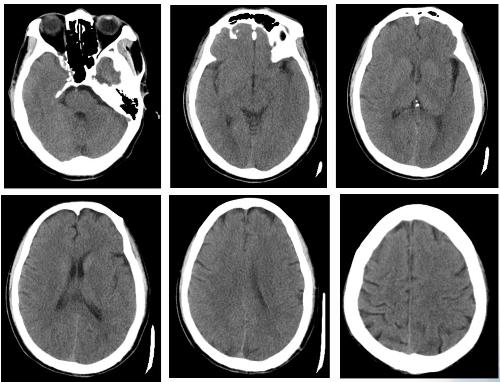 径技·例量|25期：再灌注出血—防不胜防