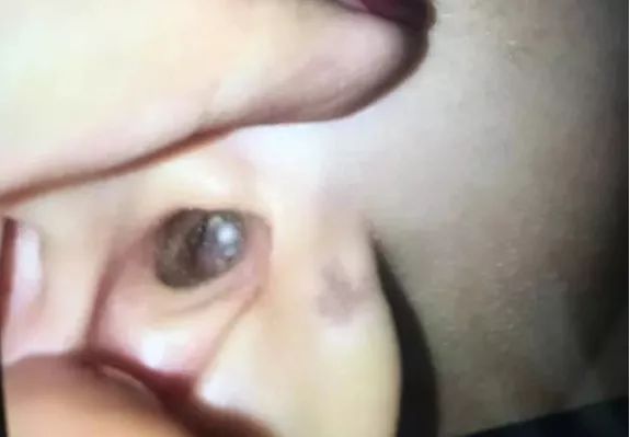 把小珠子塞耳朵里,小孩子淘气把珠子弄在耳朵里