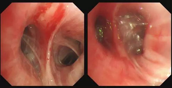 支气管镜热消融术治疗慢阻肺,西京医院支气管镜