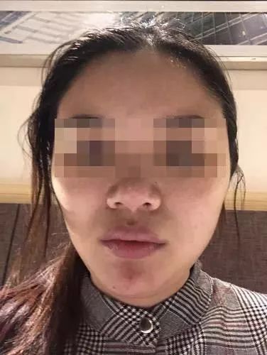 女子花3万整容后续,女子花1600万整容失败后续