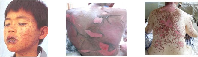 心衰肾衰伴高尿酸怎么治疗,心衰引起的肌酐和尿酸高怎么办