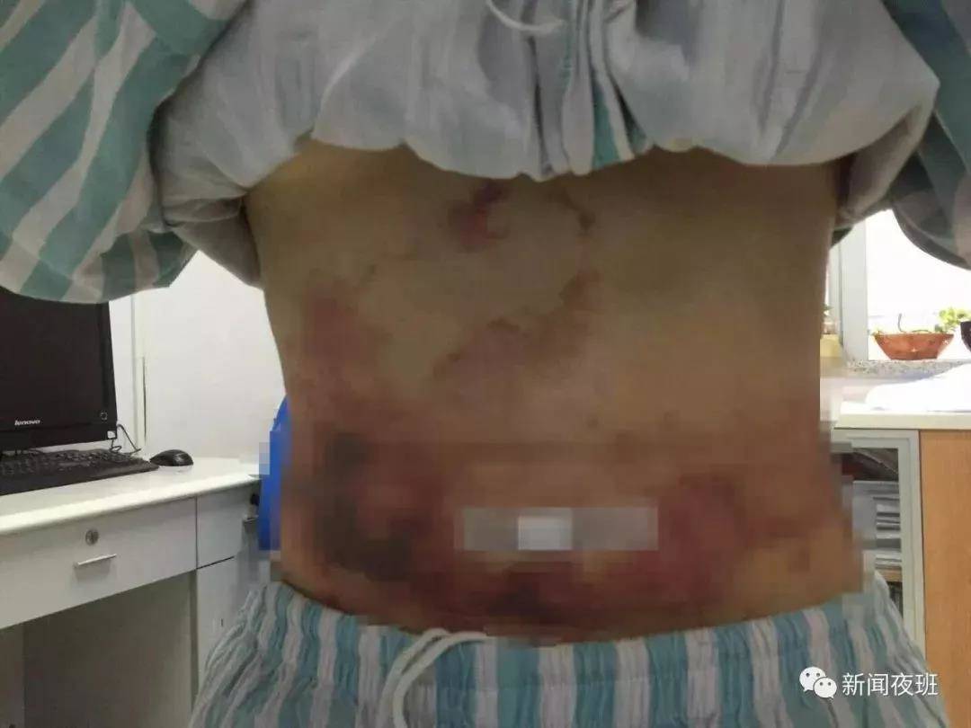 37岁女子吸脂,广西30岁姑娘吸脂