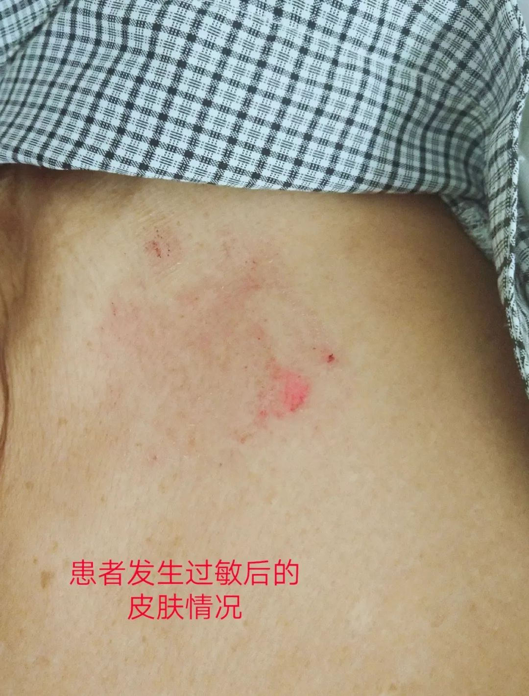 电极片皮试过敏,电极贴过敏的整改措施