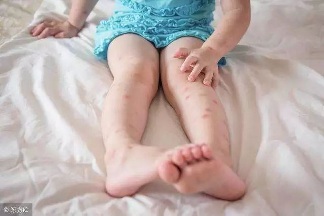 泰国蚊子叮咬止痒膏成人,蚊虫叮咬最管用泰国药膏