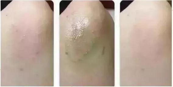 泰国蚊子叮咬止痒膏成人,蚊虫叮咬最管用泰国药膏