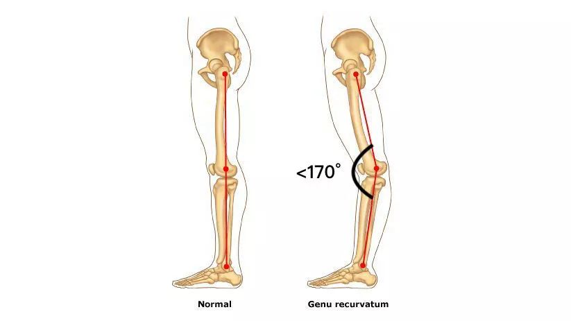 腿粗还不直小腿还外翻,怎么走路小腿才不会粗