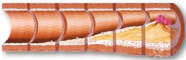 如何运动“燃掉”动脉硬化？